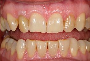 Hunters Creek Before and After Veneers